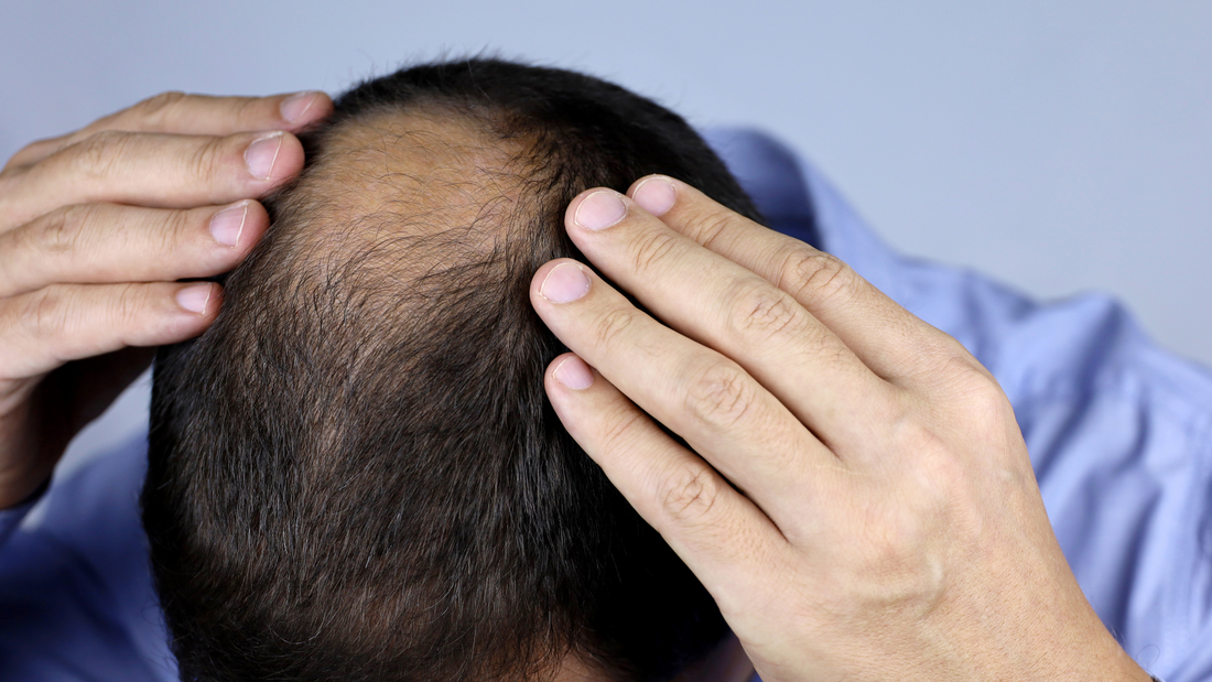 Can Hair Loss Really Be Reversed?