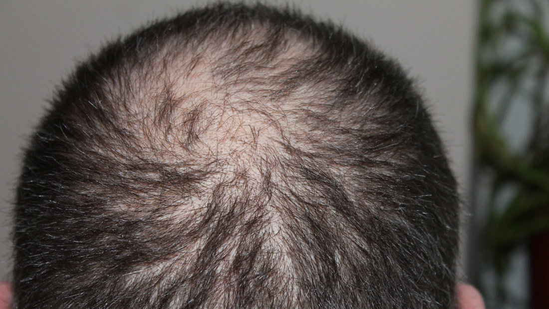 Understanding Hair Loss: Causes, Treatments, and When to Seek Expert Help