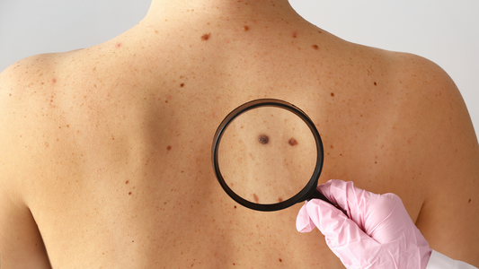 How is Mole Mapping Used to Detect Skin Cancer?