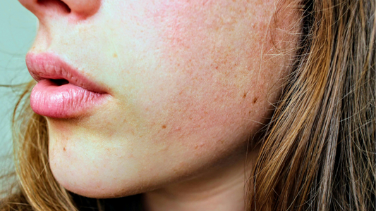 The Link Between Stress and Your Skin: Why Dermatology Should Be Part of Your Wellness Plan
